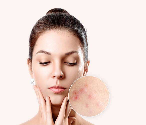 Acne Treatment by Homeopathy