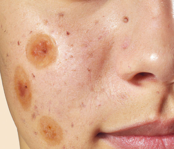 Acne Treatment by Homeopathy