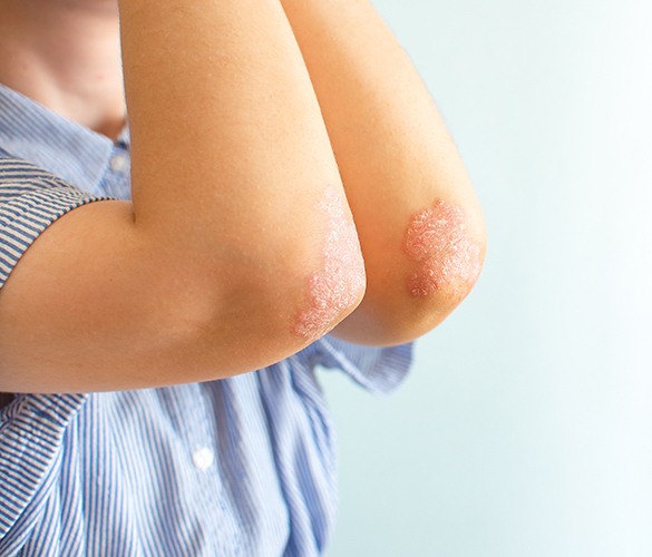 Eczema Treatment by Homeopathy