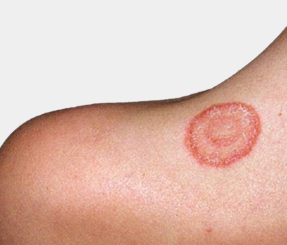 Ringworm/Fungal Infection Treatment by Homeopathy
