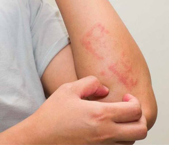 Lichen Planus Treatment by Homeopathy