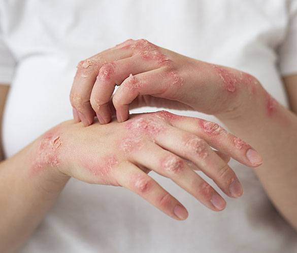 Psoriasis Treatment by Homeopathy