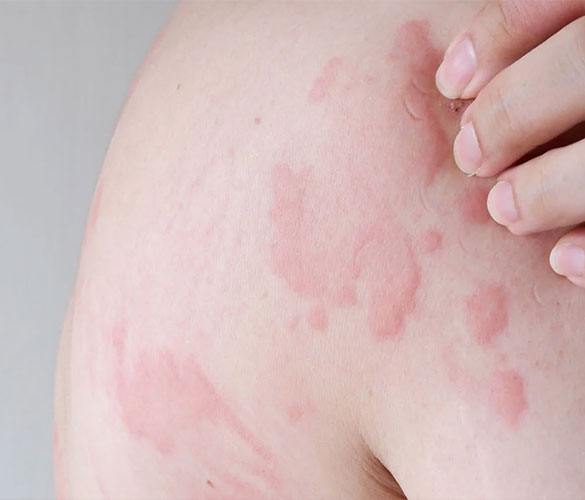 Urticaria (Hives) Treatment by Homeopathy